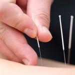 Acupuncture Technique Toronto Acupuncture Clinic