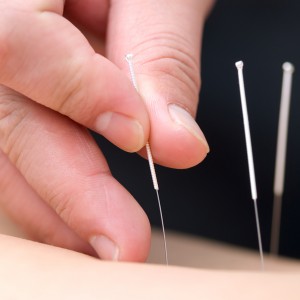 Acupuncture Technique